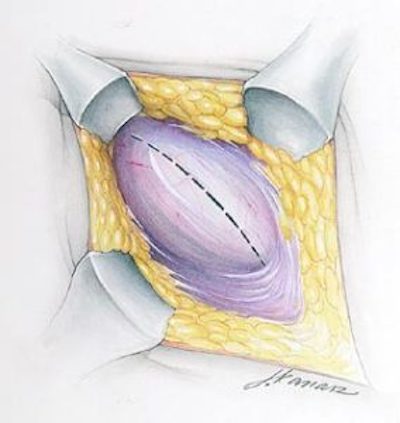 https://herniasurgeries.com/wp-content/uploads/2019/02/hernia-procedure-1a-.jpg